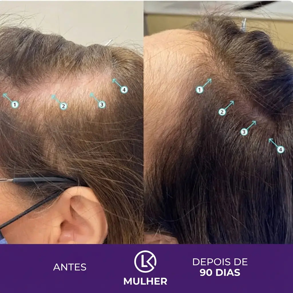 Shampoo Antiqueda e Tônico | DHT-Safe™
